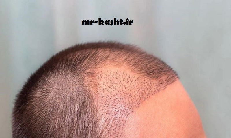 طاسی مو