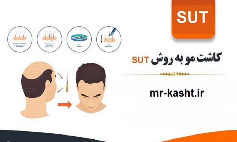 کاشت مو به روش sut